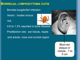 BORRELIAL LYMPHOCYTOMA CUTIS
 Borrelia burgdorferi infection
 Vector : Ixodes ricinus
tick
 0.6 to 1.3% reported in lyme disease
 Predilection site : ear lobule, nipple
and areola, nose and scrotal region
Blue-red
plaque or
nodule , 1 to
5 cm
 