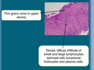 Thin grenz zone in upper
dermis
Dense, diffuse infiltrate of
small and large lymphocytes
admixed with occasional
histiocytes and plasma cells.
 