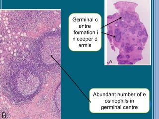 Abundant number of e
osinophils in
germinal centre
Germinal c
entre
formation i
n deeper d
ermis
 