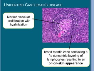 UNICENTRIC CASTLEMAN’S DISEASE
Marked vascular
proliferation with
hyalinization
broad mantle zone consisting o
f a concentric layering of
lymphocytes resulting in an
onion-skin appearance
 