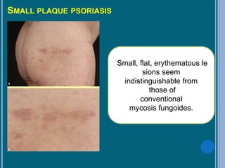 SMALL PLAQUE PSORIASIS
Small, flat, erythematous le
sions seem
indistinguishable from
those of
conventional
mycosis fungoides.
 