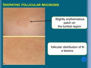 IDIOPATHIC FOLLICULAR MUCINOSIS
Slightly erythematous
patch on
the lumbal region
follicular distribution of th
e lesions
 