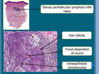 Dense perifollicular lymphoid infilt
rates
Hair follicle
Focal deposition
of mucin
Intraepithelial
lymphocytes
 