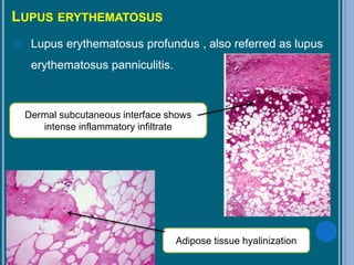 LUPUS ERYTHEMATOSUS
 Lupus erythematosus profundus , also referred as lupus
erythematosus panniculitis.
Dermal subcutaneous interface shows
intense inflammatory infiltrate
Adipose tissue hyalinization
 