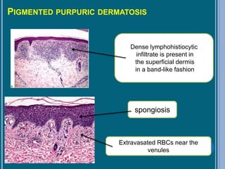 PIGMENTED PURPURIC DERMATOSIS
Dense lymphohistiocytic
infiltrate is present in
the superficial dermis
in a band-like fashion
spongiosis
Extravasated RBCs near the
venules
 