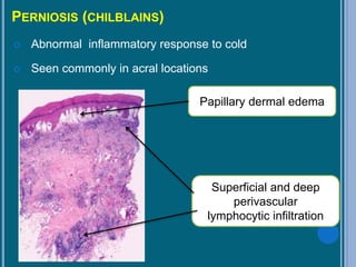 PERNIOSIS (CHILBLAINS)
 Abnormal inflammatory response to cold
 Seen commonly in acral locations
Papillary dermal edema
Superficial and deep
perivascular
lymphocytic infiltration
 