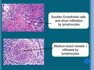 Swollen Endothelial cells
and show infiltration
by lymphocytes
Medium-sized vessels i
nfiltrated by
lymphocytes
 