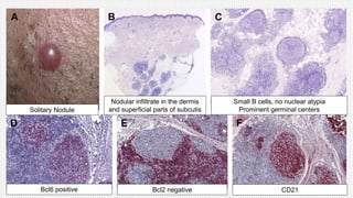 Solitary Nodule
Nodular infiltrate in the dermis
and superficial parts of subcutis
Small B cells, no nuclear atypia
Prominent germinal centers
Bcl6 positive Bcl2 negative CD21
 