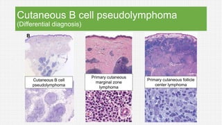 Cutaneous B cell pseudolymphoma
(Differential diagnosis)
Cutaneous B cell
pseudolymphoma
Primary cutaneous
marginal zone
lymphoma
Primary cutaneous follicle
center lymphoma
 