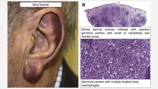 Blue Nodule
Dense dermal nodular infiltrate with reactive
germinal centers with small or completely lost
mantle zones
Germinal centers with multiple tingible body
macrophages
 