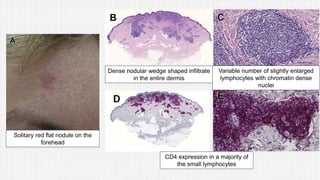 Solitary red flat nodule on the
forehead
CD4 expression in a majority of
the small lymphocytes
Variable number of slightly enlarged
lymphocytes with chromatin dense
nuclei
Dense nodular wedge shaped infiltrate
in the entire dermis
 
