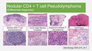 Nodular CD4 + T cell Pseudolymphoma
(Differential diagnosis)
Nodular CD4+ T cell
pseudolymphoma
Tumor stage Mycosis
Fungoides
Angioimmunoblastic T-
cell lymphoma
Tumid lupus
Dermatology 2009 (219), 42–7
 