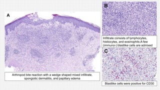 Arthropod bite reaction with a wedge shaped mixed infiltrate,
spongiotic dermatitis, and papillary edema
Infiltrate consists of lymphocytes,
histiocytes, and eosinophils.A few
(immuno-) blastlike cells are admixed
Blastlike cells were positive for CD30
 