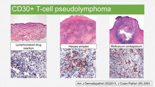 CD30+ T-cell pseudolymphoma
Am J Dermatopathol (35)2013, J Cutan Pathol (35) 2003
Lymphomatoid drug
reaction
Herpes simplex Molluscum contagiosum
 