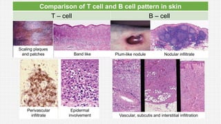 Comparison of T cell and B cell pattern in skin
T – cell B – cell
Scaling plaques
and patches Band like Plum-like nodule Nodular infiltrate
Perivascular
infiltrate
Epidermal
involvement Vascular, subcutis and interstitial infiltration
 