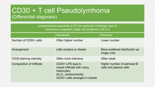 CD30 + T cell Pseudolymhoma
(Differential diagnosis)
Lymphomatoid papulosis (LYP) (in particular histologic type A)
Cutaneous anaplastic large cell lymphoma (ALCL)
Neoplastic Reactive
Number of CD30+ cells Often higher number Lower number
Arrangement Little clusters or sheets More scattered distribution as
single units
CD30 staining intensity Often more intensive Often weak
Composition of infiltrate CD30+ LPD type A:
mixed infiltrate with many
histiocytes,
ALCL: predominantly
CD30+ cells arranged in sheets
Higher number of admixed B
cells and plasma cells
 