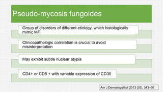 Pseudo-mycosis fungoides
Group of disorders of different etiology, which histologically
mimic MF
Clinicopathologic correlation is crucial to avoid
misinterpretation
May exhibit subtle nuclear atypia
CD4+ or CD8 + with variable expression of CD30
Am J Dermatopathol 2013 (35), 343–50
 