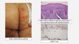 Scaly, erythematous patches
CD8+ T cell
Inflammatory infiltrate of atypical lymphocytes in
the superficial dermis with epidermotropism
 