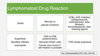 Lymphomatoid Drug Reaction
Adults
Macular or
papular eruptions
CCBs, ACE inhibitors,
antidepressants,
antihistamines, beta-
blockers,
benzodiazepines, lipid-
lowering agents
Superficial,
Bandlike infiltrate,
eosinophils
CD4 or CD8
predominance,
Admixed CD30+ cells
Caveat: loss of pan-T-
cell markers is possible
TCR mostly polyclonal
Am J Dermatopathol 2013 (35), 343–50
 
