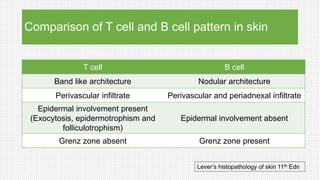 Comparison of T cell and B cell pattern in skin
T cell B cell
Band like architecture Nodular architecture
Perivascular infiltrate Perivascular and periadnexal infiltrate
Epidermal involvement present
(Exocytosis, epidermotrophism and
folliculotrophism)
Epidermal involvement absent
Grenz zone absent Grenz zone present
Lever’s histopathology of skin 11th Edn
 
