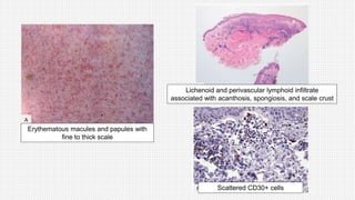 Erythematous macules and papules with
fine to thick scale
Lichenoid and perivascular lymphoid infiltrate
associated with acanthosis, spongiosis, and scale crust
Scattered CD30+ cells
 