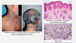 Ill-defined confluent lichenified plaques involving the face,
neck, and extending into the torso.
Acanthosis, parakeratosis, spongiosis,
and prominent eosinophils
CD8+ cells
 