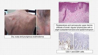 Dry, scaly and pruriginous erythroderma
Parakeratosis and perivascular upper dermis
infiltrate of small, regular lymphocytes with a
slight subepidermal band and epidermotropism
CD3 + and CD8+ cells
 