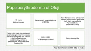 Papuloerythroderma of Ofuji
70 years
Male > Female
Generalized, especially trunk
and limbs
Itchy flat topped red to brownish
papules, erythoderma with (deck
chair sign), palmoplantar
hyperkeratosis,
lymphadenopathy
Pattern of chronic dermatitis with
a variable epidermal hyperplasia
with mild spongiosis and a mixed
inflammatory infiltrate,
predominately consist of
lymphocytes, histiocytes and
eosinophils
CD4 = CD8
TCR mostly polyclonal
Blood eosinophilia
Acta Derm Venereol 2009 (89), 618–22.
 