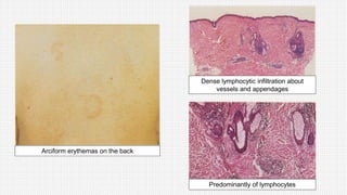 Arciform erythemas on the back
Dense lymphocytic infiltration about
vessels and appendages
Predominantly of lymphocytes
 