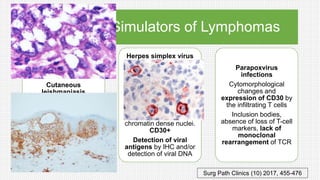 Infections as Simulators of Lymphomas
Cutaneous
leishmaniasis
Lymphocytes,
histiocytes, and plasma
cells
Detection of the agents
Herpes simplex virus
and varicella zoster
virus
Without the
pathognomonic epithelial
changes (herpes
incognito)
Lymphocytes enlarged
and atypical-appearing
chromatin dense nuclei.
CD30+
Detection of viral
antigens by IHC and/or
detection of viral DNA
Parapoxvirus
infections
Cytomorphological
changes and
expression of CD30 by
the infiltrating T cells
Inclusion bodies,
absence of loss of T-cell
markers, lack of
monoclonal
rearrangement of TCR
Surg Path Clinics (10) 2017, 455-476
 