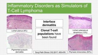 Inflammatory Disorders as Simulators of
T-Cell Lymphoma
Lichen planus (6%) Lichen sclerosis et
atrophicus (13%)
Pigmented purpuric
dermatitis Pityriasis lichenoides (60%)
Interface
dermatitis
Clonal T-cell
populations have
been found
Surg Path Clinics (10) 2017, 455-476
 