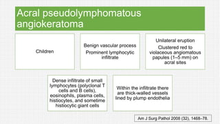 Acral pseudolymphomatous
angiokeratoma
Children
Benign vascular process
Prominent lymphocytic
infiltrate
Unilateral eruption
Clustered red to
violaceous angiomatous
papules (1–5 mm) on
acral sites
Dense infiltrate of small
lymphocytes (polyclonal T
cells and B cells),
eosinophils, plasma cells,
histiocytes, and sometime
histiocytic giant cells
Within the infiltrate there
are thick-walled vessels
lined by plump endothelia
Am J Surg Pathol 2008 (32), 1468–78.
 