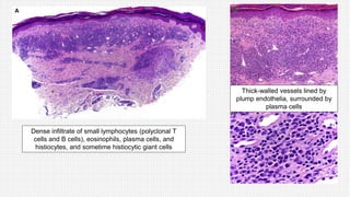 Dense infiltrate of small lymphocytes (polyclonal T
cells and B cells), eosinophils, plasma cells, and
histiocytes, and sometime histiocytic giant cells
Thick-walled vessels lined by
plump endothelia, surrounded by
plasma cells
 