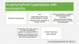 Angiolymphoid hyperplasia with
eosinophilia
Epithelioid hemangioma
M=F
Angiomatous pink to red-
brown papules or nodules
Head and neck, especially on
the face and ears
Dermal proliferates of capillary
vessels with prominent
endothelia
Dense lymphocytic infiltrate
with reactive germinal centers
and eosinophils
Endothelial cells were positive
for CD31 and ERG but
negative for podoplanin/D2-40.
Majority of lymphocytes are of
T-cell lineage. Admixed B cells
may form lymphoid follicles.
Clonal T cells have
been detected
J Am Acad Dermatol 2016 (74), 506–512
 