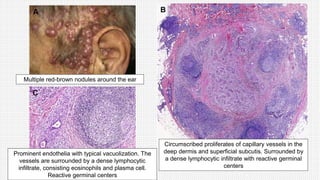 Prominent endothelia with typical vacuolization. The
vessels are surrounded by a dense lymphocytic
infiltrate, consisting eosinophils and plasma cell.
Reactive germinal centers
Multiple red-brown nodules around the ear
Circumscribed proliferates of capillary vessels in the
deep dermis and superficial subcutis. Surrounded by
a dense lymphocytic infiltrate with reactive germinal
centers
 