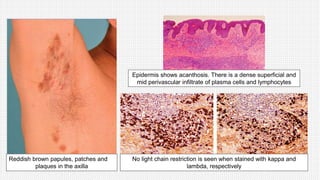 Reddish brown papules, patches and
plaques in the axilla
Epidermis shows acanthosis. There is a dense superficial and
mid perivascular infiltrate of plasma cells and lymphocytes
No light chain restriction is seen when stained with kappa and
lambda, respectively
 