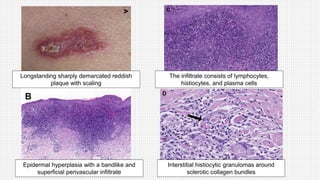 Longstanding sharply demarcated reddish
plaque with scaling
The infiltrate consists of lymphocytes,
histiocytes, and plasma cells
Epidermal hyperplasia with a bandlike and
superficial perivascular infiltrate
Interstitial histiocytic granulomas around
sclerotic collagen bundles
 