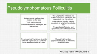 Pseudolymphomatous Folliculitis
Solitary nodule preferentially
located on the face
T-cell predominance.
Admixed epithelioid histiocytes and
granulomas
The lymphocytic infiltrates are
located throughout the dermis and
may extend into the subcutis
The epidermis spared. There is
exocytosis of lymphocytes into the
hair
A hyperplasia of eccrine and
apocrine ducts is often observed
An admixture of numerous dendritic
cells with expression of CD1a and
S-100 was identified in all cases.
Unusual high number
(approximately 50% of the cases)
of clonal T cells
Am J Surg Pathol 1999 (23),1313–9.
 