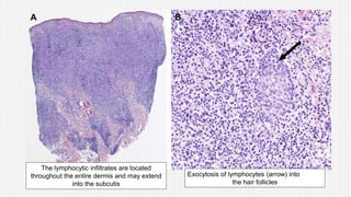 The lymphocytic infiltrates are located
throughout the entire dermis and may extend
into the subcutis
Exocytosis of lymphocytes (arrow) into
the hair follicles
 