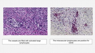 The vessels are filled with activated large
lymphocytes
The intravascular lymphocytes are positive for
CD30
 