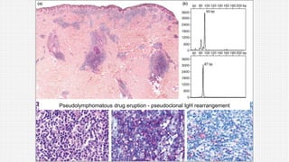 Pseudolymphomatous drug eruption - pseudoclonal IgH rearrangement
 