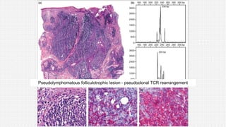 Pseudolymphomatous folliculotrophic lesion - pseudoclonal TCR rearrangement
 