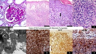Case of SLE presenting with Mycosis Fungoides
 