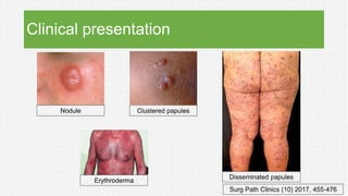 Clinical presentation
Nodule Clustered papules
Disseminated papules
Erythroderma
Surg Path Clinics (10) 2017, 455-476
 