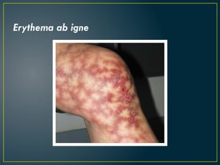 Erythema ab igne
 