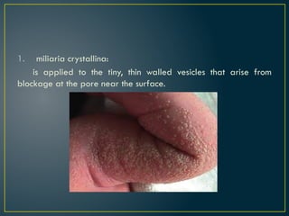 1. miliaria crystallina:
is applied to the tiny, thin walled vesicles that arise from
blockage at the pore near the surface.
 