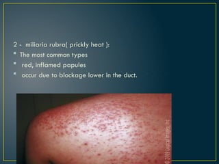 2 - miliaria rubra( prickly heat ):
 The most common types
 red, inflamed papules
 occur due to blockage lower in the duct.
 