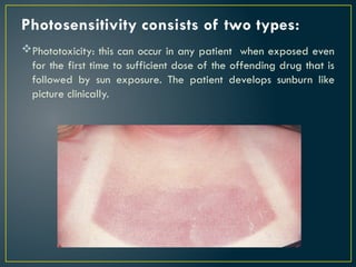 Photosensitivity consists of two types:
Phototoxicity: this can occur in any patient when exposed even
for the first time to sufficient dose of the offending drug that is
followed by sun exposure. The patient develops sunburn like
picture clinically.
 