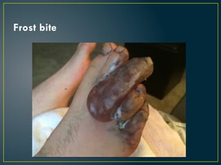 Frost bite
 