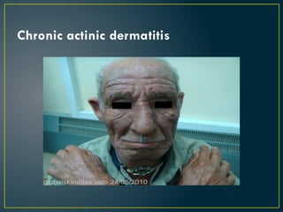 Chronic actinic dermatitis
 